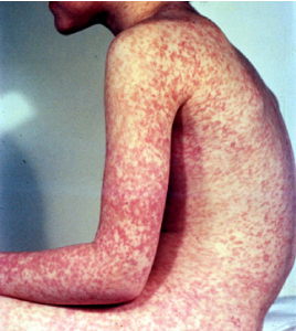 pictures of measles in adults #11