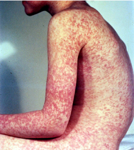 Facts about Measles for Adults - Adult Vaccination